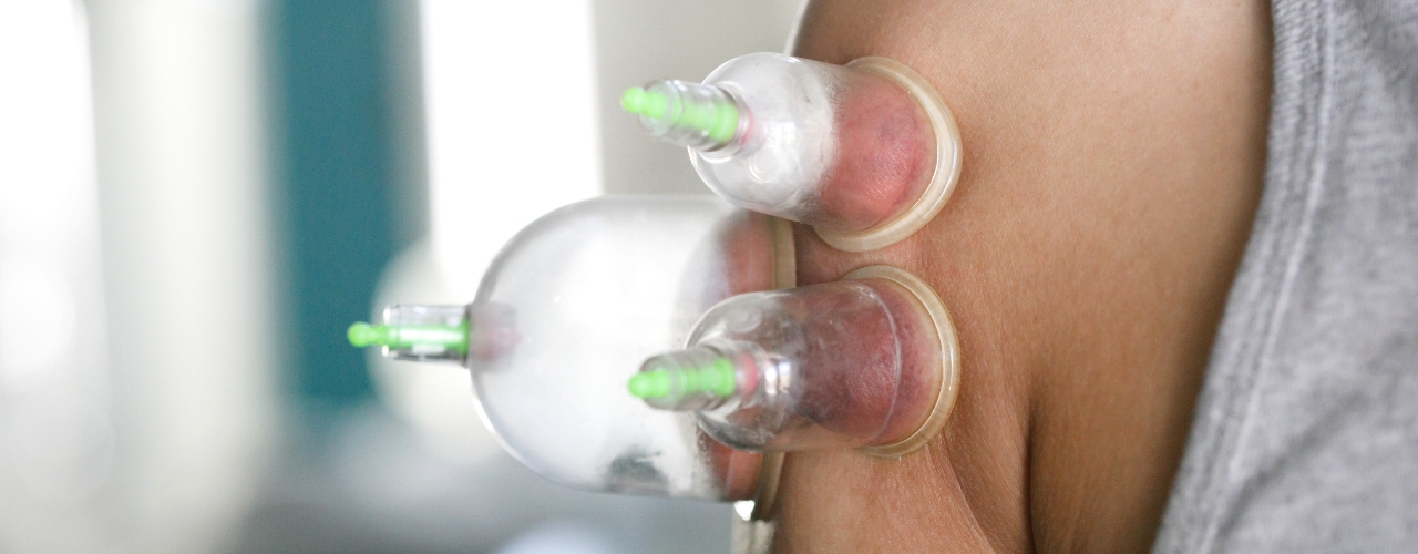 Cupping-Cascade-Hand-&-Orthopedic-Rehab-Fort-Meyers-FL