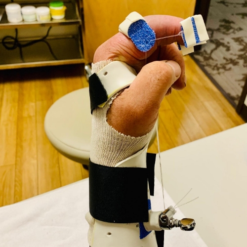 Custom-Orthosis-Splinting-2-Cascade-Hand-Orthopedic-Rehab-Fort-Meyers-FL