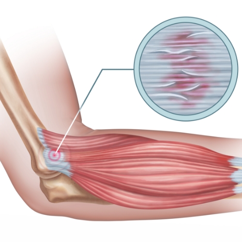 Extensor-tendon-injury-Cascade-Hand-&-Orthopedic-Rehab-Fort-Meyers-FL