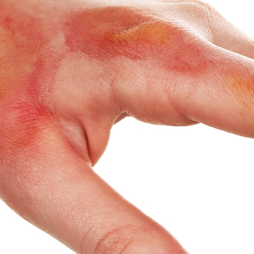 Hand-burns-Cascade-Hand-&-Orthopedic-Rehab-Fort-Meyers-FL