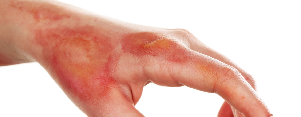 Hand-infections-Cascade-Hand-&-Orthopedic-Rehab-Fort-Meyers-FL