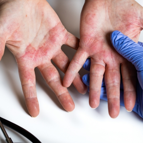 Hand-infections-Cascade-Hand-&-Orthopedic-Rehab-Fort-Meyers-FL