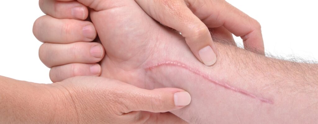 Scar-tissue-Cascade-Hand-&-Orthopedic-Rehab-Fort-Meyers-FL