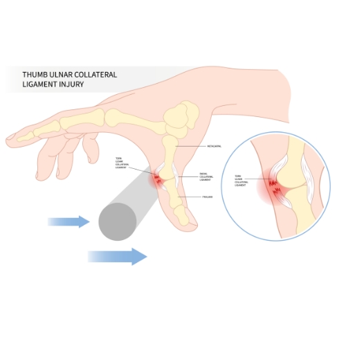 Ulnar-collateral-ligament-use-injury-of-the-thumb-Cascade-Hand-&-Orthopedic-Rehab-Fort-Meyers-FL